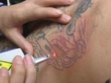 Клетки кожи научили сводить татуировки самостоятельно
